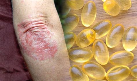 omega-3s for psoriasis